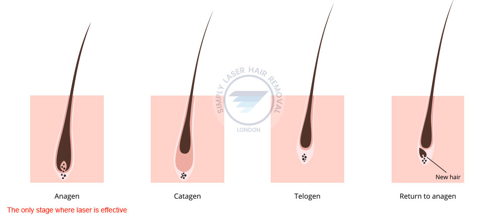 Hair growth phase/cycle and laser treatment
