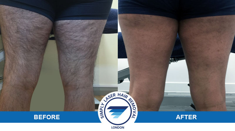 laser hair removal for men before and after