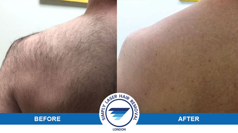 Laser Hair Removal for Men