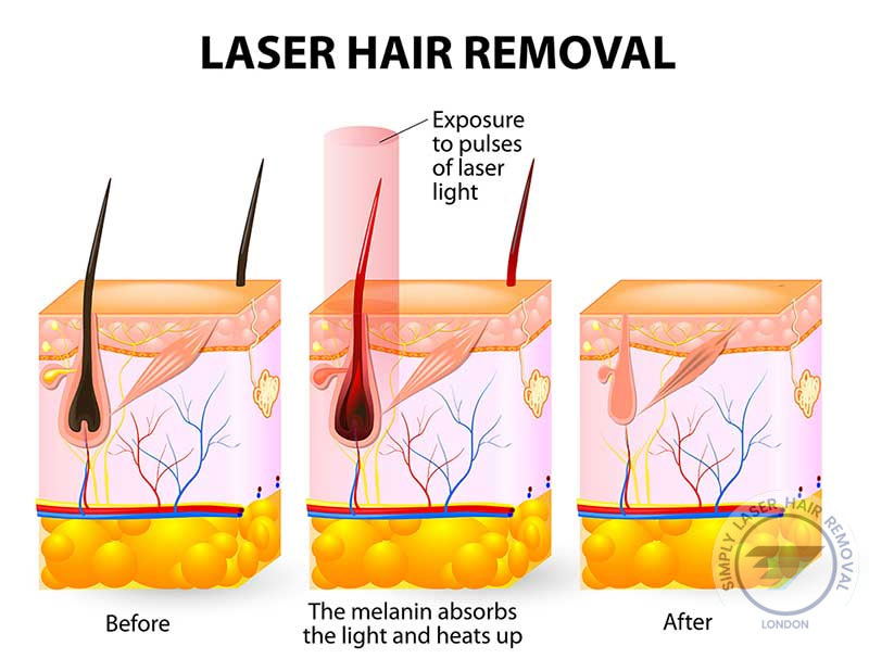 Laser Hair Removal London | Simply Laser Hair Removal