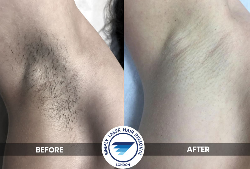 Laser Hair Removal London | Simply Laser Hair Removal