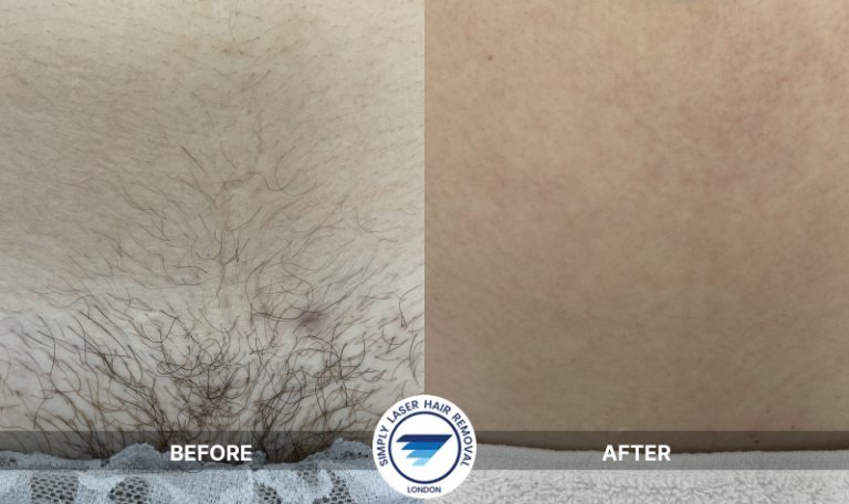 After bikini and navel line laser hair removal treatment; visibly reduced hair, smoother skin, softened ingrown scars
