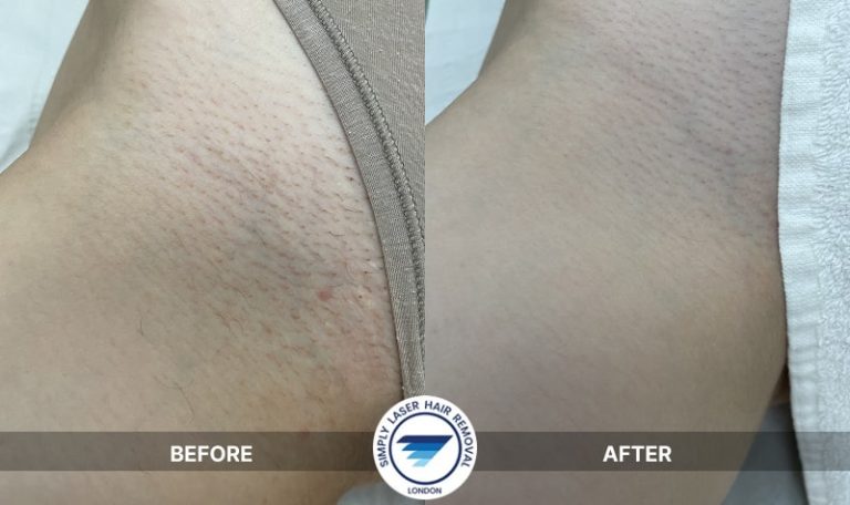 Laser hair removal on bikini, Brazilian & Hollywood areas: reduced redness, no shaving rash, and visible hair reduction.