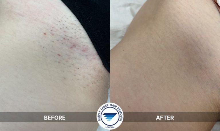 Laser hair removal on bikini, Brazilian and Hollywood areas; softer hair, no shaving & ingrown rash, and minimal regrowth.