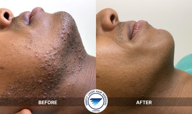 Laser Hair Removal Results: Dark-Skinned Male Beard & Neck Smoother Skin, Fewer Ingrown Hairs & Reduced Pseudofolliculitis barbae After Yag Laser Treatment