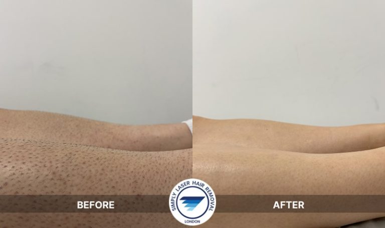 Laser Hair Removal Results: Full Legs & Thighs Silky Smooth Skin, Reduced Hair Regrowth & Fewer Ingrown Scars After Professional Treatment in London