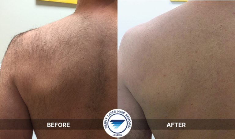 Before & after men's laser hair removal-full back & shoulders treated with Alexandrite laser at Simply laser hair removal & skin clinic